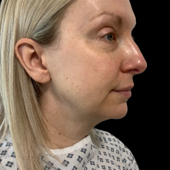 before-deep-plane-facelift-necklift